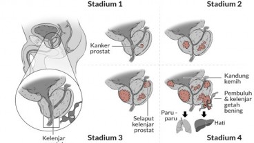 Kenali Faktor Risiko Kanker Prostat dan Gejalanya