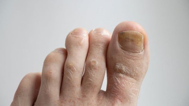 Ketahui Tanda-tanda Kanker Kulit Melanoma dari Kuku Anda