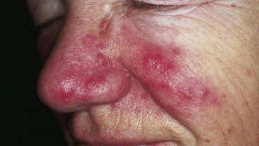 Apa Sih Rosacea Itu, Penyakit Kulit yang Diderita Maia Estianty