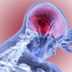 Pendarahan Otak: Jenis, Penyebab, dan Gejala
