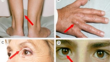 Awas Kolesterol Tinggi! Cek Tandanya di Tangan, Lutut, dan Hidung