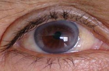Ada Cincin Putih di Sekitar Kornea Mata ? Bisa Jadi Tanda Kolesterol Tinggi