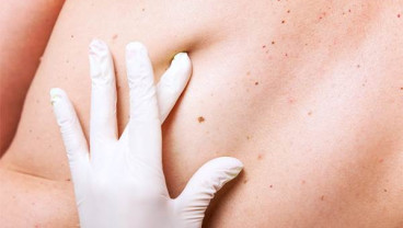Perubahan Tahi Lalat dan Warna Urin Bisa Jadi Tanda Kanker Kulit Melanoma