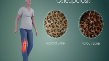 Siapa Paling Berisiko Terkena Osteoporosis, dan Cara Mengendalikannya