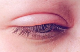 Kekurangan Vitamin D Bisa Berakibat Buruk pada Mata Anda