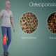 Ini 3 Bagian Tubuh yang Paling Rentan Mengalami Osteoporosis