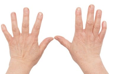 6 Tanda Awal Rheumatoid Arthritis, Segera Periksakan ke Dokter