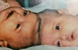 Viral Kisah Melawan Takdir Dokter Padmosantjojo, Bawa Keajaiban Operasi Kembar Siam Dempet Kepala