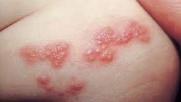 Ini Gejala Herpes Zoster atau Cacar Air Api