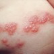 Ini Gejala Herpes Zoster atau Cacar Air Api