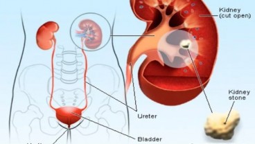  7 Tips Mencegah Batu Ginjal