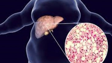 Kebiasaan Buruk yang Berbahaya untuk Liver Anda