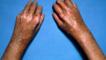 Kenali 10 Gejala Diabetes dari Masalah Kulit