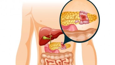 Cek Tanda-tanda Kanker Pankreas yang Seringkali Diabaikan