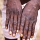 Spanyol Konfirmasi 30 Kasus Cacar Monyet (Monkeypox), Terkait Sauna Pria