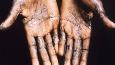 Apa Itu Cacar Monyet (Monkeypox)? Ini Asal-usul, Gejala, Penularan