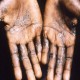 Apa Itu Cacar Monyet (Monkeypox)? Ini Asal-usul, Gejala, Penularan