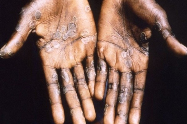 Ilustrasi tangan seseorang terinfeksi virus cacar monyet atau Monkeypox/BBC