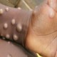 WHO: 92 Kasus Cacar Monyet (Monkeypox) dari Afrika Barat, Berikut Sebarannya di 12 Negara