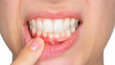 Penyebab dan Cara Mencegah Gingivitis, Jangan Anggap Enteng!