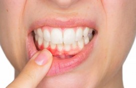 Penyebab dan Cara Mencegah Gingivitis, Jangan Anggap Enteng!