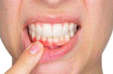 Penyebab dan Cara Mencegah Gingivitis, Jangan Anggap Enteng!