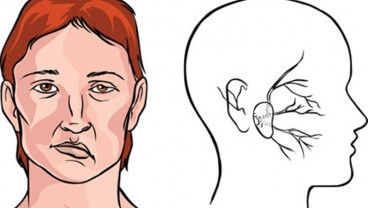 Bedanya Bell’s Palsy dan Ramsay Hunt Syndrome