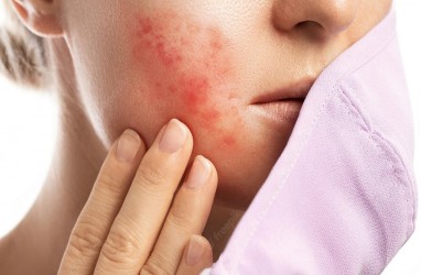 13 Tips Jitu Menghindari Maskne, Jerawat Akibat Pakai Masker 