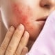 13 Tips Jitu Menghindari Maskne, Jerawat Akibat Pakai Masker 