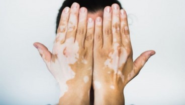 Kenali Penyebab dan Gejala Vitiligo yang Timbulkan Bercak Putih di Wajah dan Tubuh