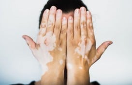 Kenali Penyebab dan Gejala Vitiligo yang Timbulkan Bercak Putih di Wajah dan Tubuh