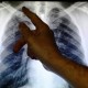 Cara Alami Membersihkan Paru-paru Anda, Penting untuk Perokok