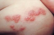 Menular Lewat Udara, Berikut 10 Fakta Tentang Herpes Zoster