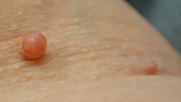 Ada Bintil di Kulit Leher dan Ketiak? Waspada Tanda Diabetes