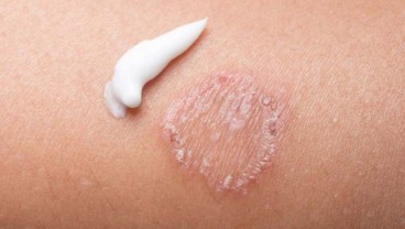 Ini 10 Cara Mengobati Penyakit Ringworm
