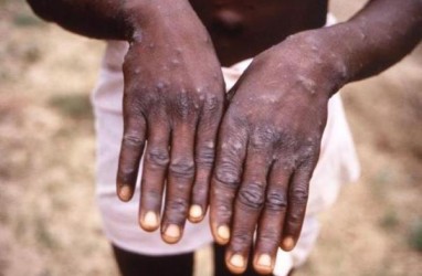 Temuan Baru, Singapura Catat 9 Kasus Positif Monkeypox Sejak Juni 2022