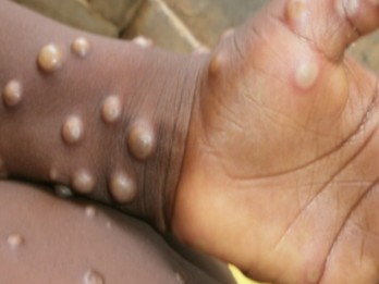 50 Strain Baru Monkeypox Ditemukan