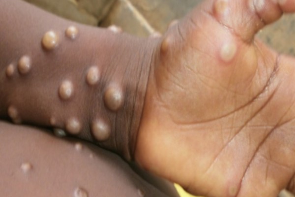 Penyakit cacar monyet atau monkeypox mewabah di Inggris, Portugal dan Spanyol./Istimewa