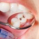 Hal Penting yang Harus Dilakukan Sebelum Mencabut Gigi