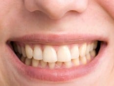Cara Membersihkan Karang Gigi di Rumah, Mudah dan Murah