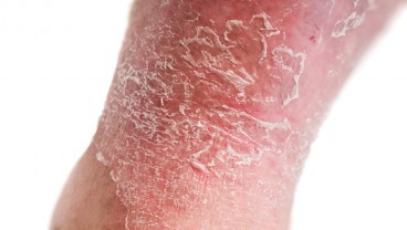 Kulit Eksim dan Psoriasis, Ini Cara Merawatnya