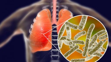 Gejala Pneumonia Misterius, Penyakit yang Disebabkan Bakteri Legionnaires