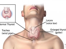 Ciri-ciri Gangguan Tiroid yang Muncul di Pagi Hari