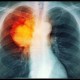 Gejala dan Penyebab Umum Kanker Paru-Paru, Perokok Aktif Harus Waspada!