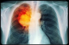 Gejala dan Penyebab Umum Kanker Paru-Paru, Perokok…