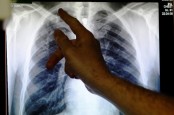 Cara Membersihkan Paru-paru Secara Alami untuk Perokok