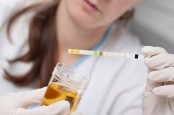 Urine Berbusa Tanda Bocor Ginjal, Ini Cara Pemeriksaannya