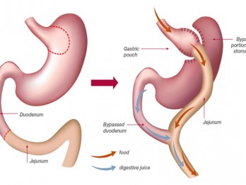 Dibanderol Sekitar Rp100 Juta, Apakah Bedah Bariatrik Efektif dan Aman?