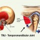 Apa Itu Temporomandibular Joint, Penyebab dan Cara Menanganinya