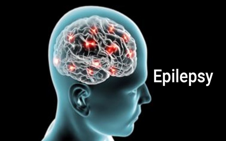 Gejala Awal Epilepsi, Jangan Diabaikan